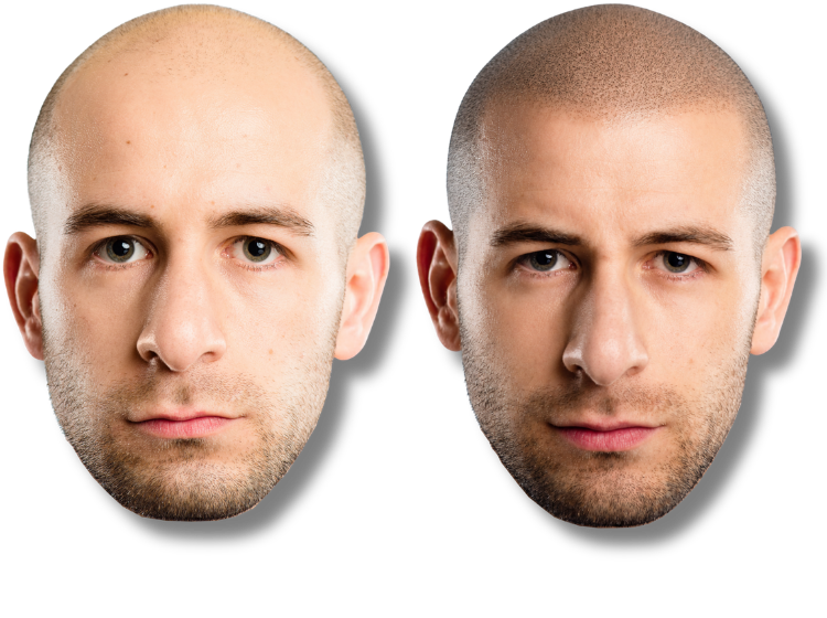 Before and after scalp micropigmentation results for male pattern baldness and hair density.