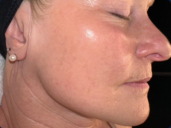 after mcironeedling results after 4 procedures