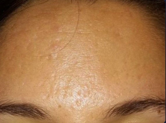 after mcironeedling results after 6 procedures