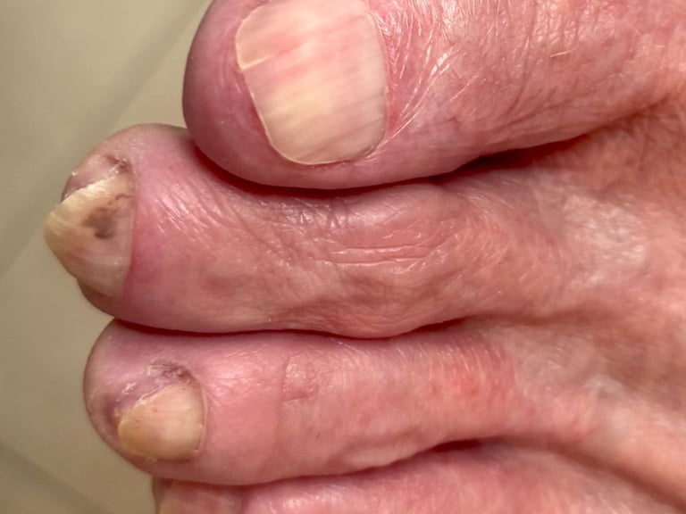 Medical Pedicure in Boise Idaho client with Toe Nail Fungus