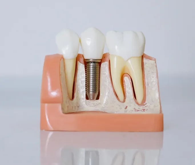  Implantes dentales en Sevilla