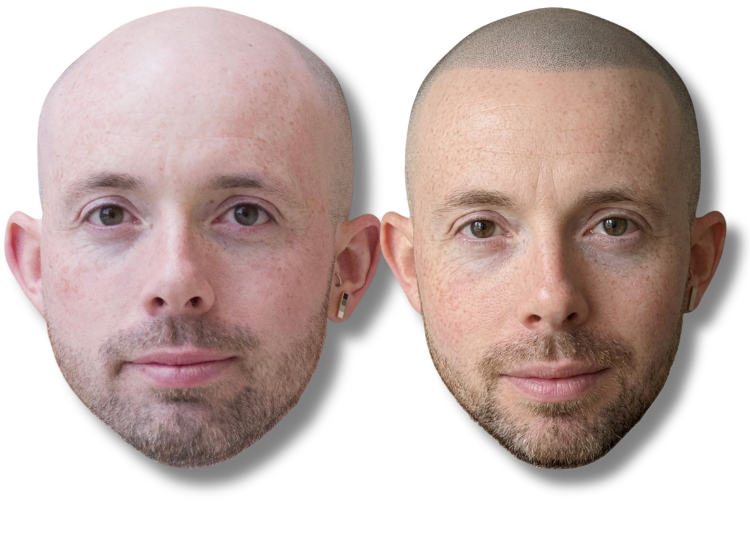 Before and after scalp micropigmentation results for a man with a bald head and thinning hair.