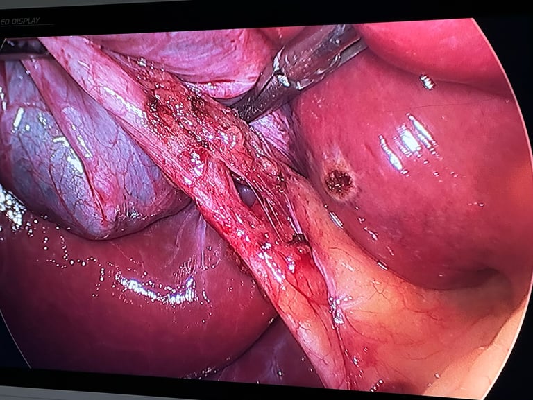 realizando a cirurgia de calculos biliares