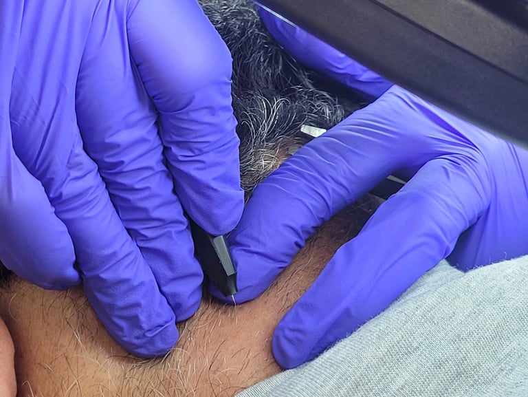 Hair removal Electrolysis Edmonton