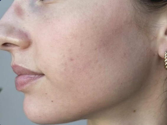 before mcironeedling results after 4 procedures