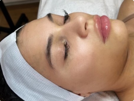 after mcironeedling results after 6 procedures