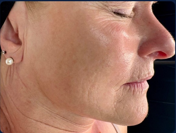 before mcironeedling results after 3 procedures