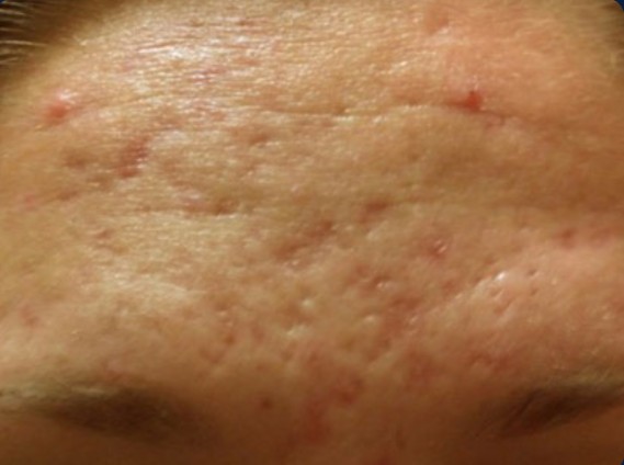 before mcironeedling results after 6 procedures