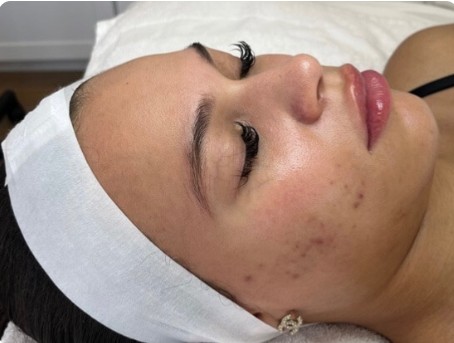 before mcironeedling results after 6 procedures
