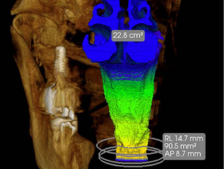 tomografia vias aéreas
