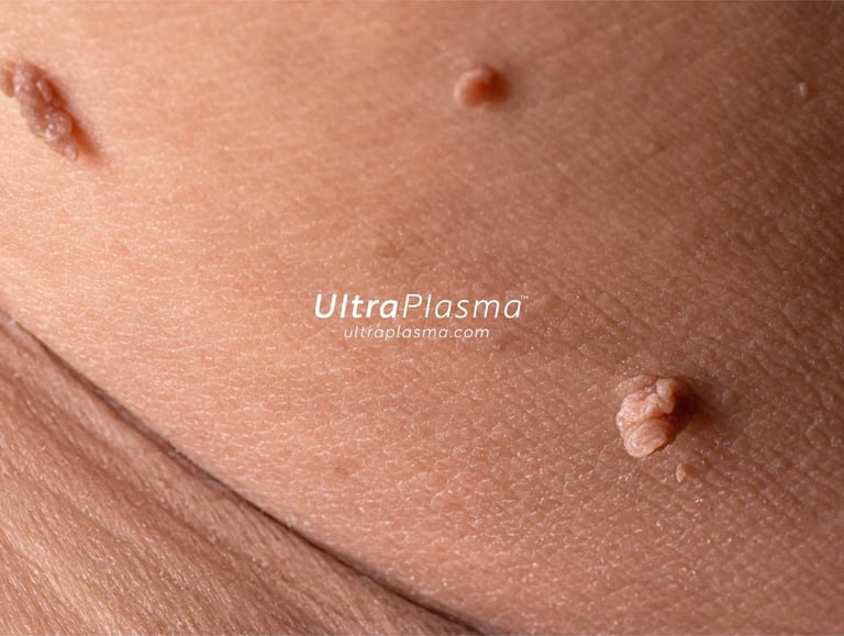 ultraplasma.com_wart_treatment_sigil_tedavisi_ultra_plasma_ultra_plazma_genital