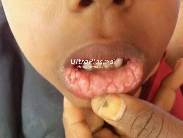 ultraplasma.com_wart_treatment_sigil_tedavisi_ultra_plasma_ultra_plazma_mouth_agiz