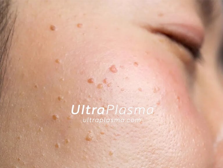 ultraplasma.com_wart_treatment_sigil_tedavisi_ultra_plasma_ultra_plazma_mouth_agiz