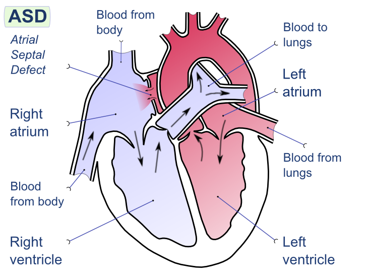 Arterial Septal Defect