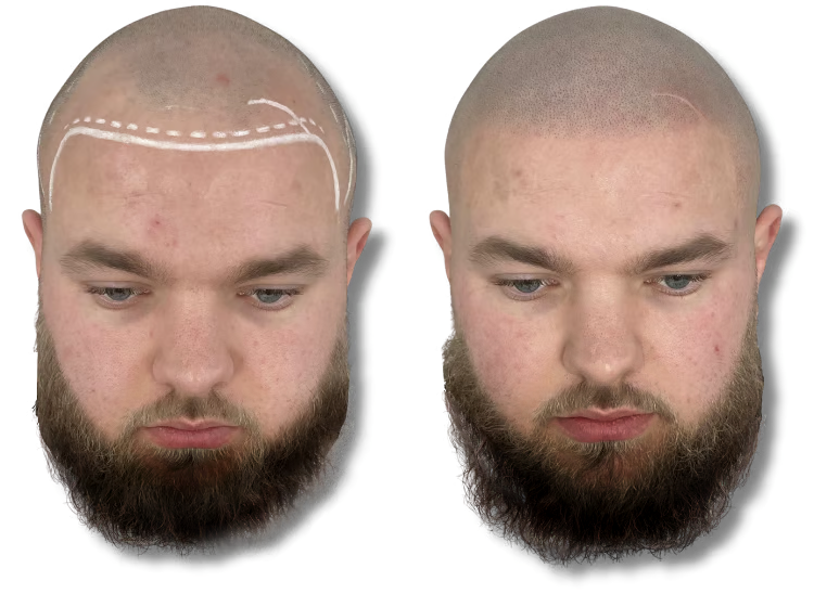 Before and after scalp micropigmentation treatment for male pattern baldness hairline restoration.
