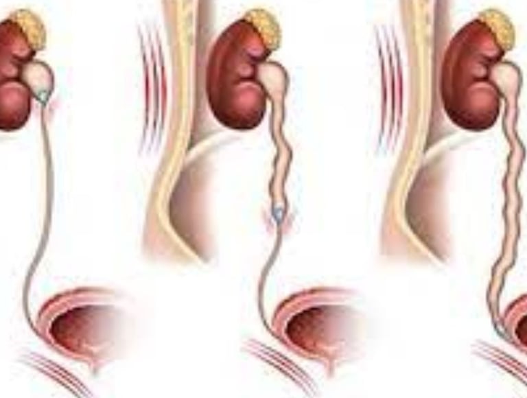 ureteric stone