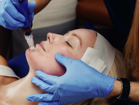 Microneedling treatment fine lines skin rejuvenation performed by a doctor