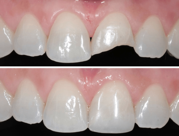 foto restauração do dente