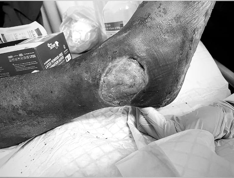 a person with a leg wound in a hospital bed