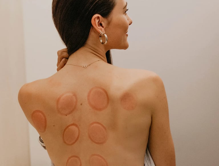 Terapia com Ventosas