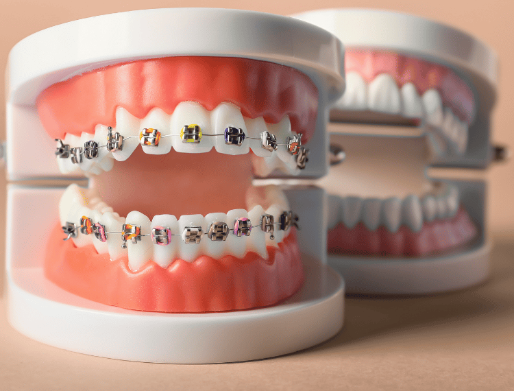 زراعة الأسنان - عيادة طب الاسنان دكتور وسام علي العباسي