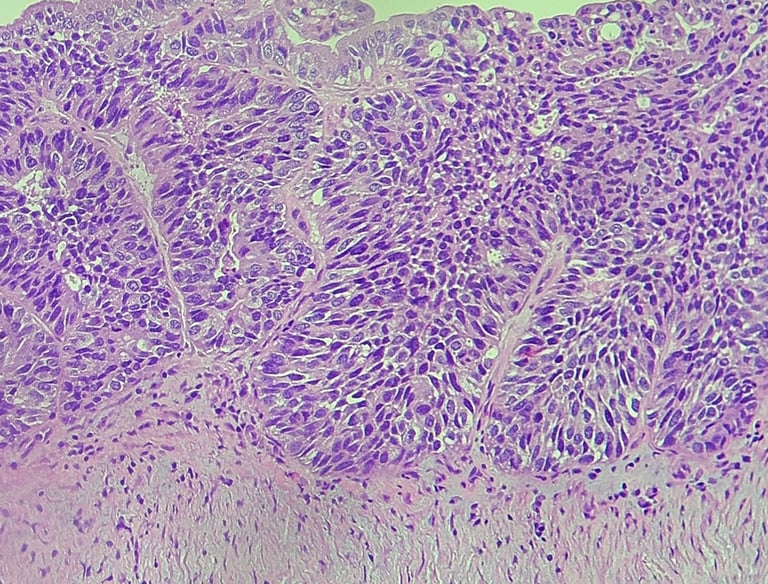 Câncer de ovário, lâmina de microscópio, fotomicrografia, hematoxilina & eosina, adenocarcinoma