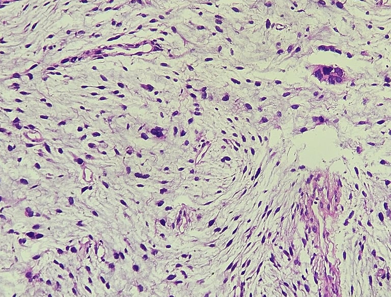 Sarcoma, Partes Moles, Tumores raros