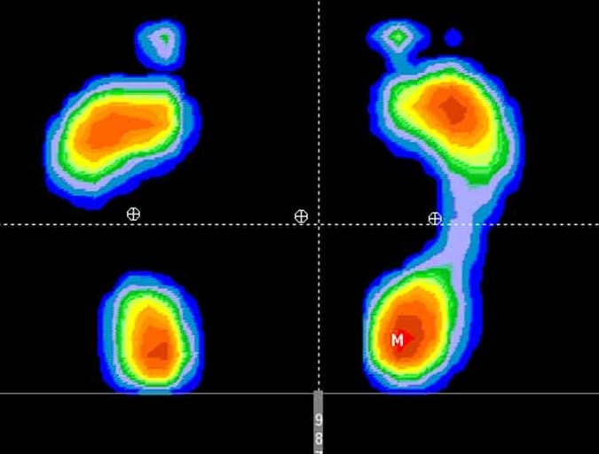 estudio pisada marcha plantillas illescas toledo