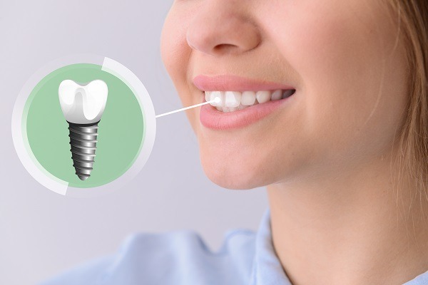 dental implant specialist baner
