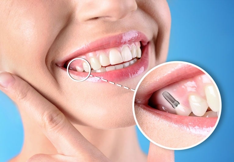permanent tooth replacement in baner