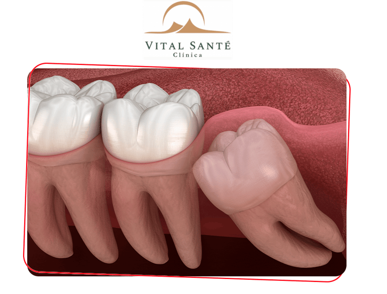 dentes siso, cirurgia de siso, dentista recreio