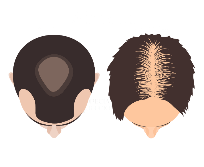 calculadora de injerto capilar según área de alopecia