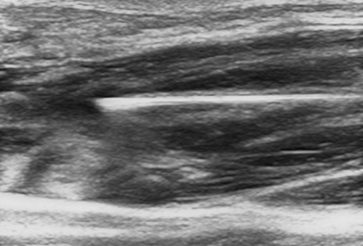 venous ultrasound varicose vein leg pain swelling treatment imaging scan thrombosis blood clot symptoms treatment risk perth