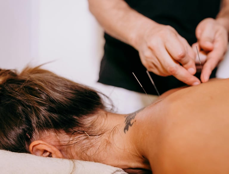 Woman getting dry needles placed to treat muscle pain and tension