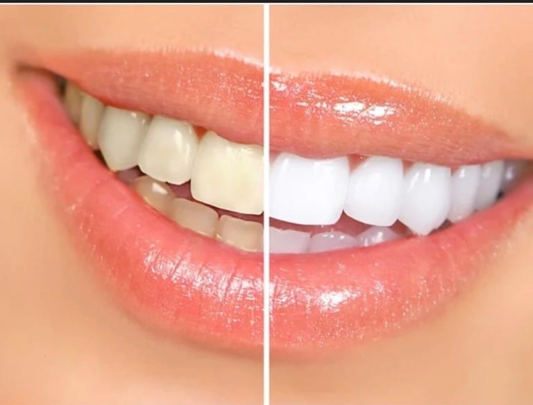 teeth whitening with laser