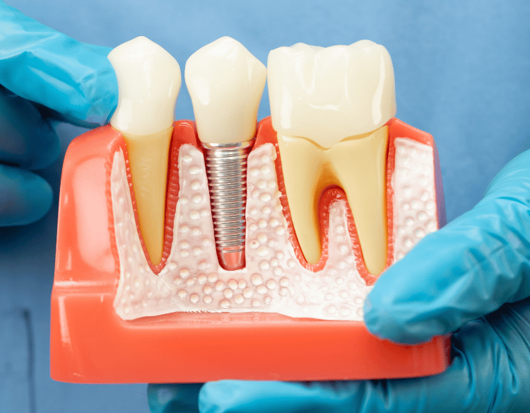 زراعة الأسنان - عيادة طب الاسنان دكتور وسام علي العباسي