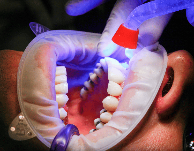 زراعة الأسنان - عيادة طب الاسنان دكتور وسام علي العباسي