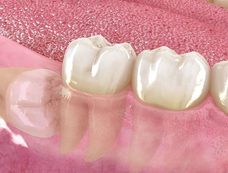 extraccion de cordales sin dolor