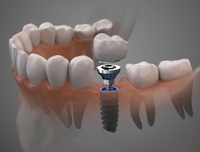 Implantes Dentales en Santo Domingo