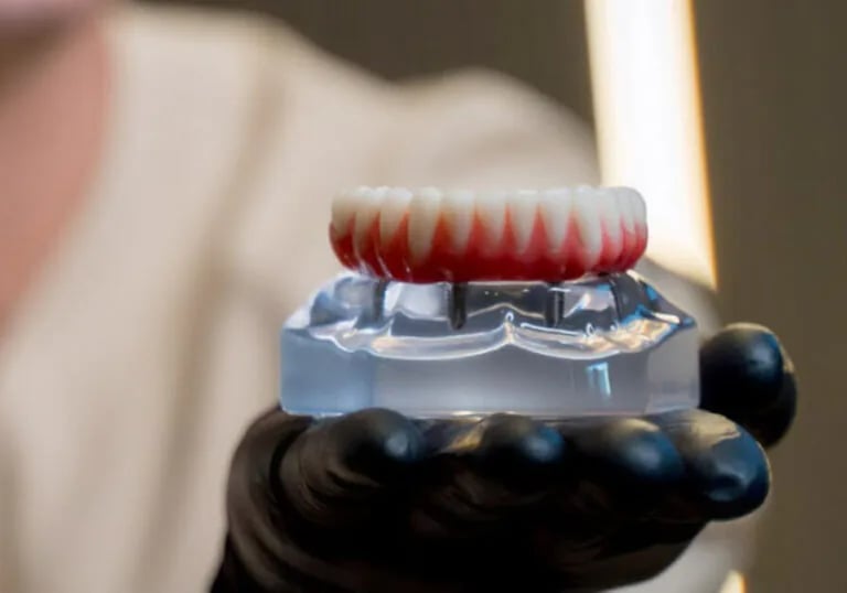 Tratamentos com implante dentário e seus benefícios