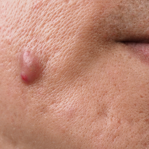 xérese de Cistos Sebáceos, Lipomas e Nevus