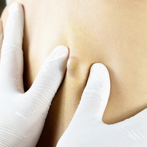 Retorno pós-operatório com orientações de curativo após cirurgia de cisto pilonidal.