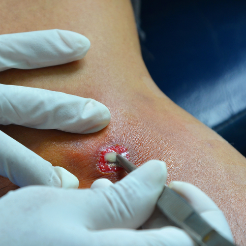 Drenagem de Abscessos