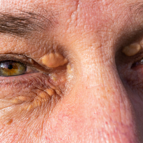 Close-up de pálpebra com xantelasma amarelo no canto interno, fundo neutro suave.