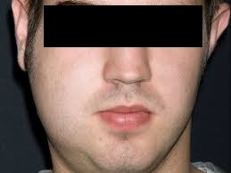 Σιελαδενίτιδα διόγκωση παρωτίδας παρωτίδα όγκος σιελογόνοι αδένες Καβάλα