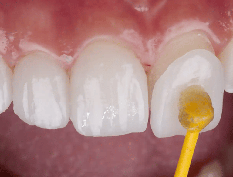 Faccette dentali, denti bianchi