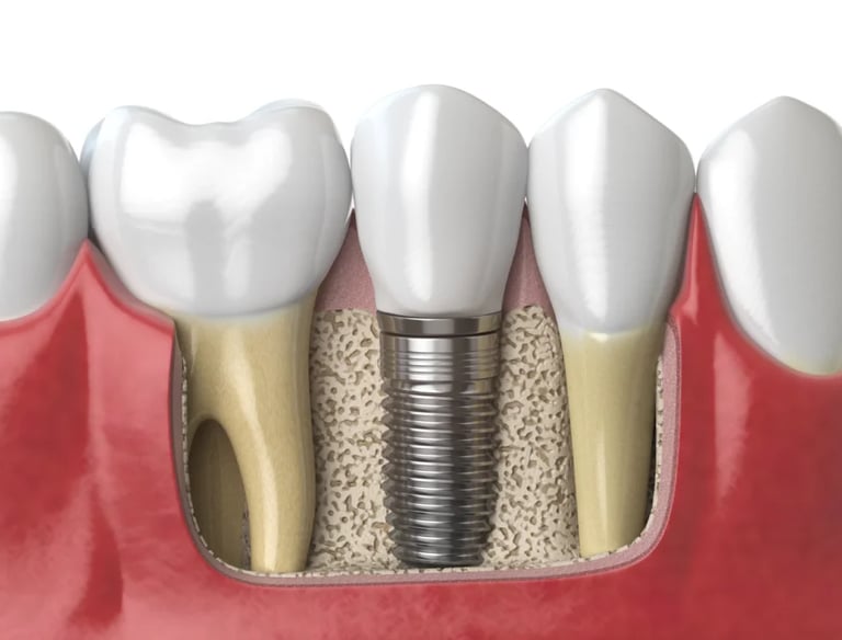 Impianto dentale dente