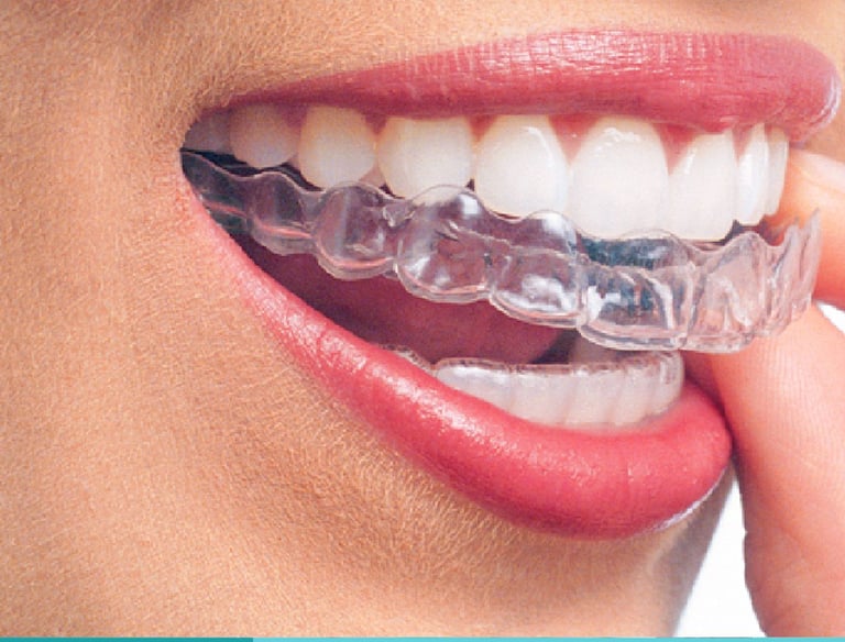 Mascherine invisibili, Invisalign, Clear Correct