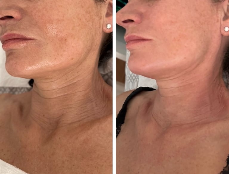Red Carpet facial before/after jawline lift NYC