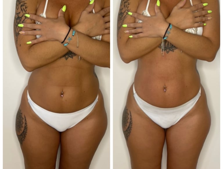Body contouring before and after results at-home sculpting treatment NYC by SkinBeautyElite. 
